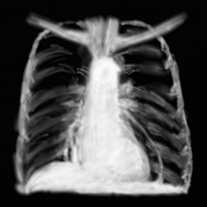 RP pneumomédiastin