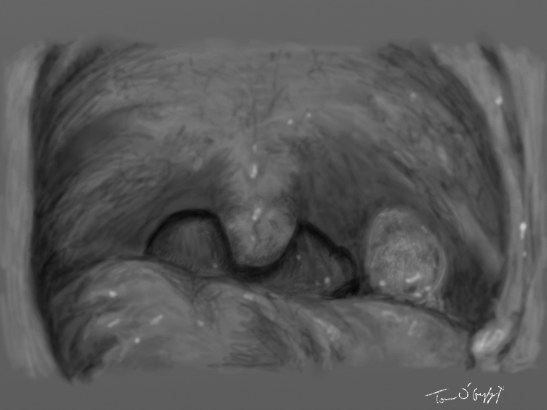 angine ulcero necrotique de Vincent