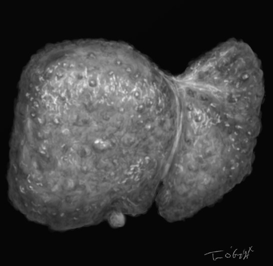 cirrhose hepatique micronodulaire