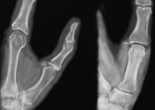 entorse metacarpo phalangienne pouce radiographie