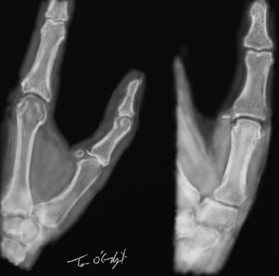 entorse metacarpo phalangienne pouce radiographie