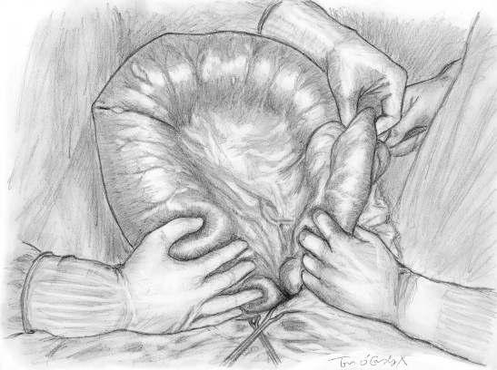 volvulus colon sigmoide