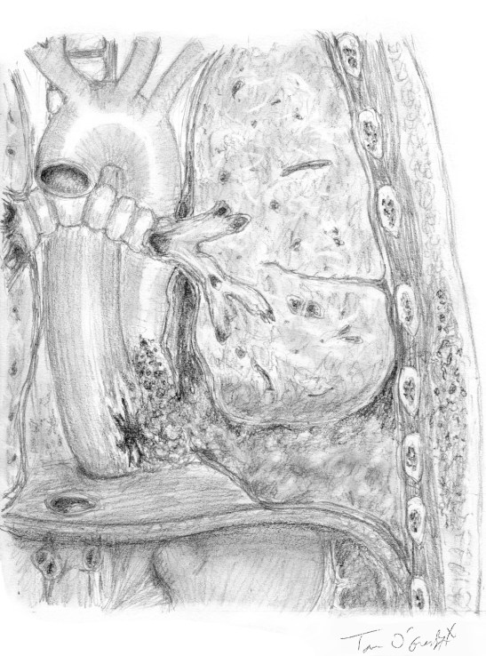 syndrome de Boerhaave rupture oesophage