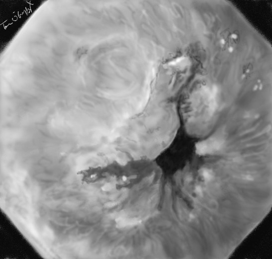 syndrome de Mallory Weiss