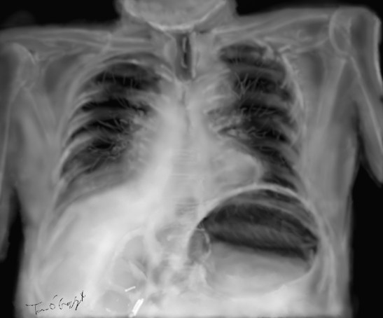 dilatation aigue estomac