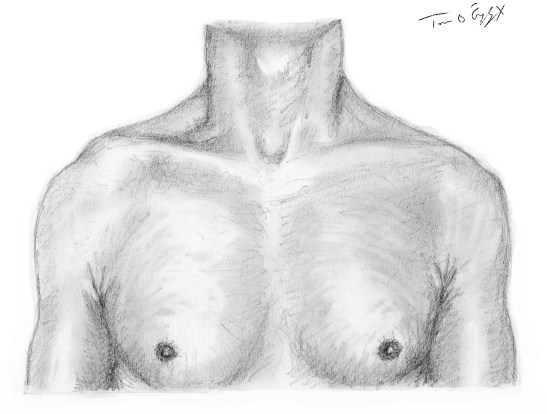 entorse disjonction acromio claviculaire