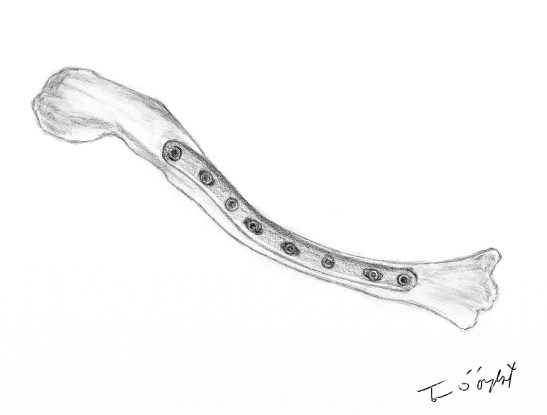 fracture clavicule osteosynthese plaque