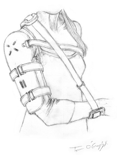 fracture diaphyse humerus