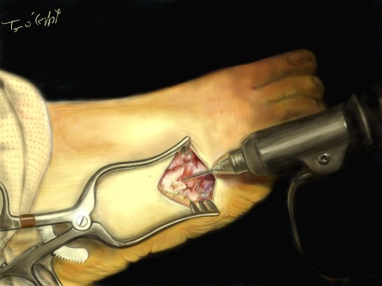 fracture fatigue metatarsien