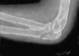 fracture olecrane