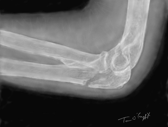 fracture olecrane