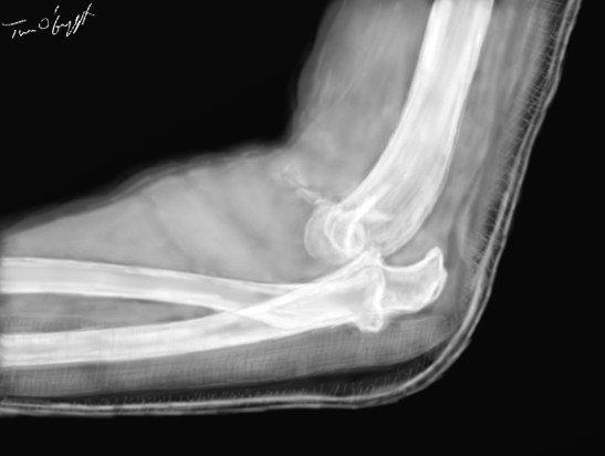 luxation coude radiographie