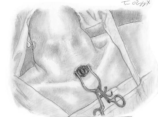 mediastinostomie sus sternale