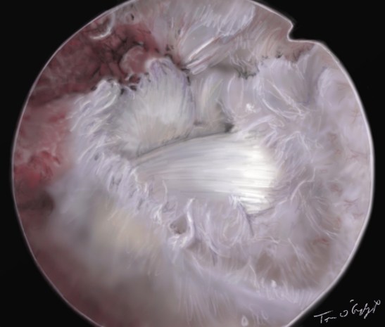 rupture coiffe rotateur arthroscopie