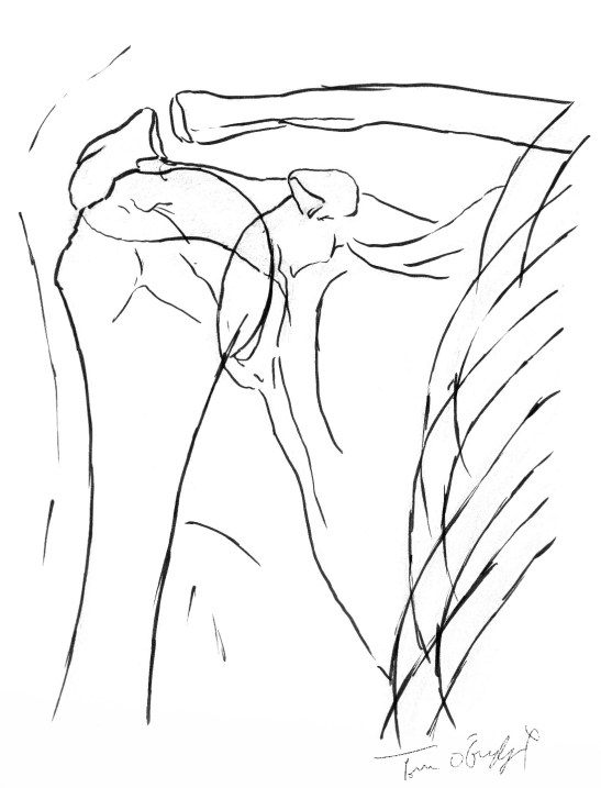 rupture coiffe rotateurs radiographie