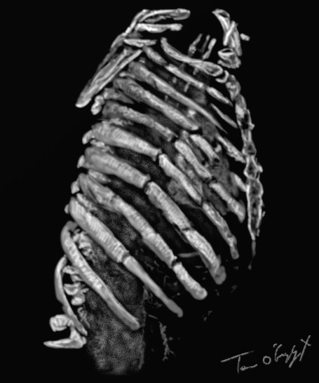 volet costal thoracique