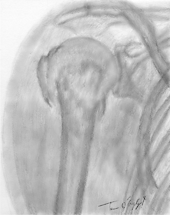 fracture tete humerale