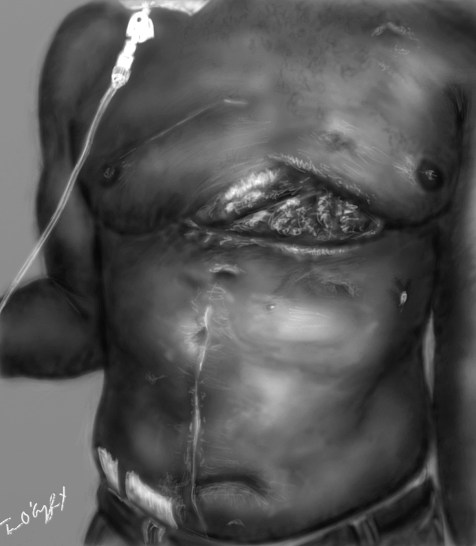 thoracotomie cicatrice reconstruction