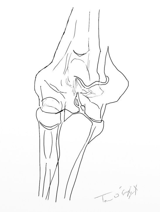 palette humerale radiographie