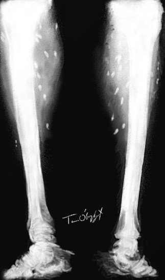 cysticercose calcifications radiographie