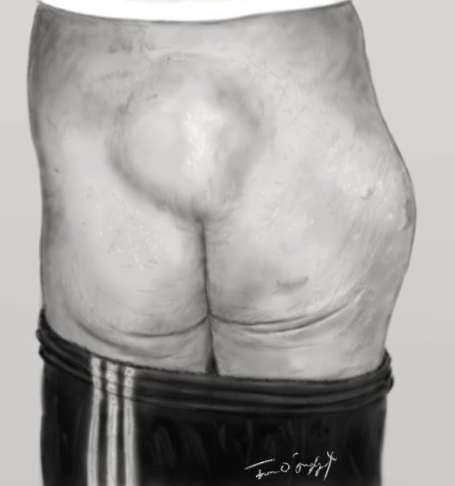 epanchement de Morel Lavallee