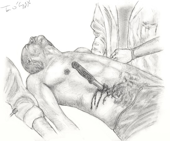 Plaie abdomen arme blanche