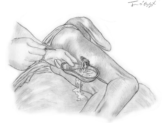 abces cuisse incision