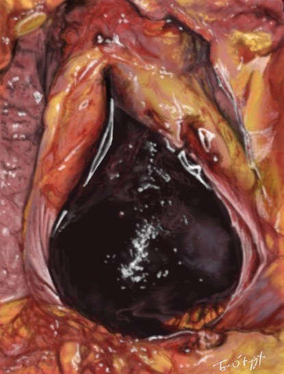 tamponnade hemopericarde
