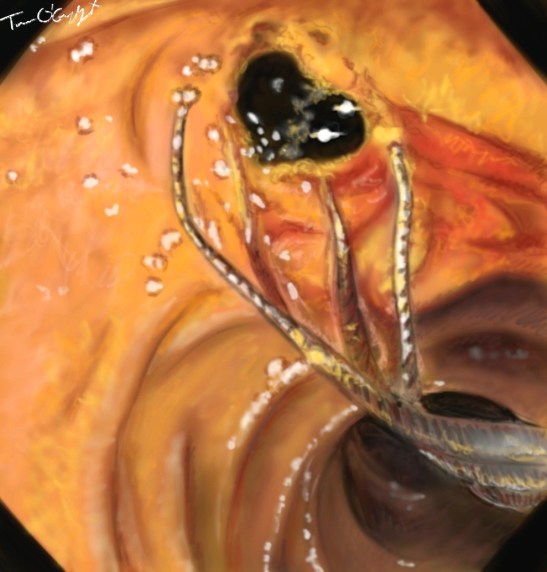 angiocholite endoscopie lithiase choledoque