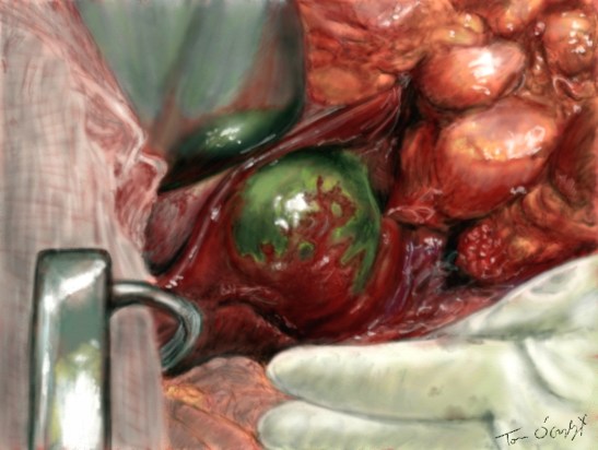 cholecystite lithiasique