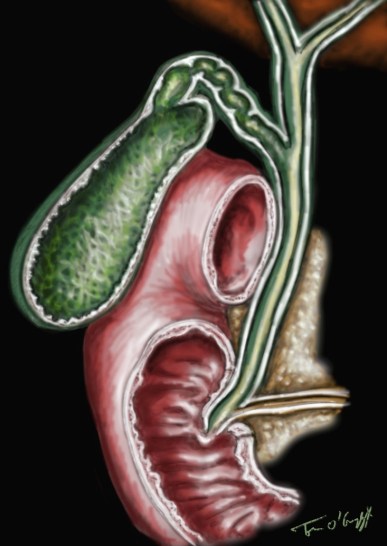 voies biliaires colique hepatique