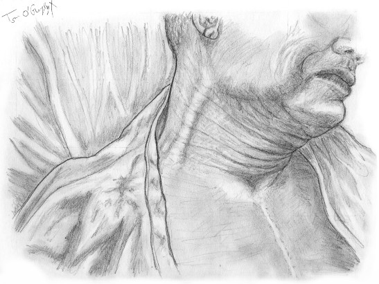 insuffisance cardiaque turgescence jugulaire