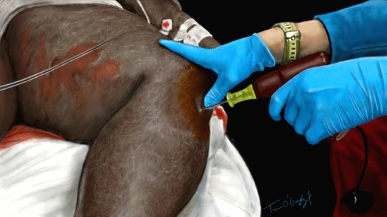 accès vasculaire intra osseux tibial