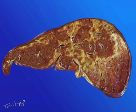 intoxication paracetamol foie