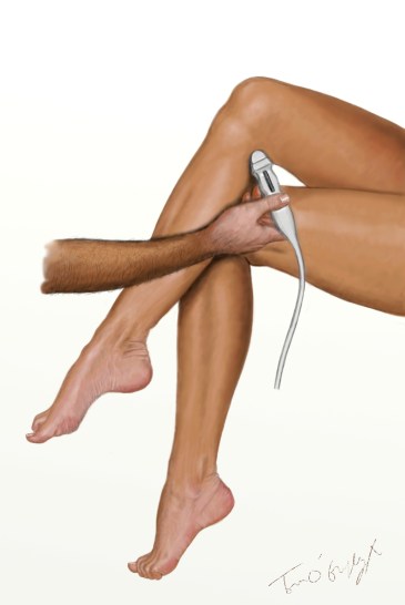 phlébite doppler jambes