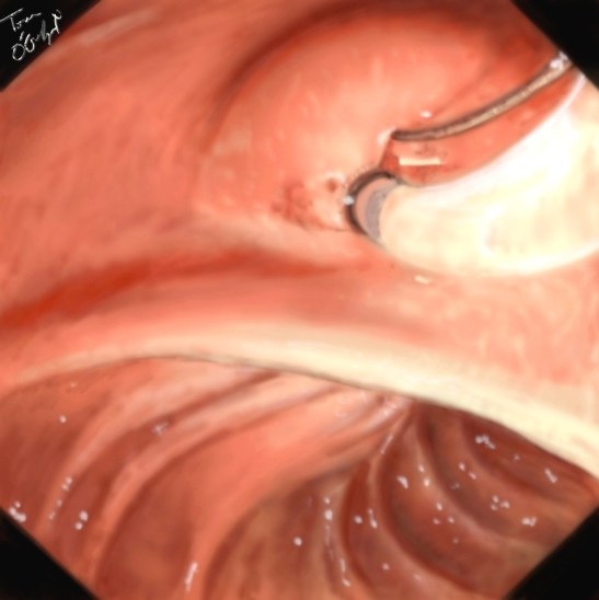 spinctérotomie endoscopique CPRE
