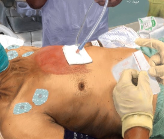 drainage pericardique