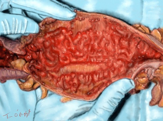 rectocolite MICI Crohn