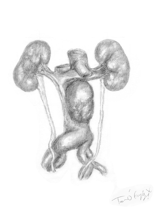 anevrysme aorte abdominale