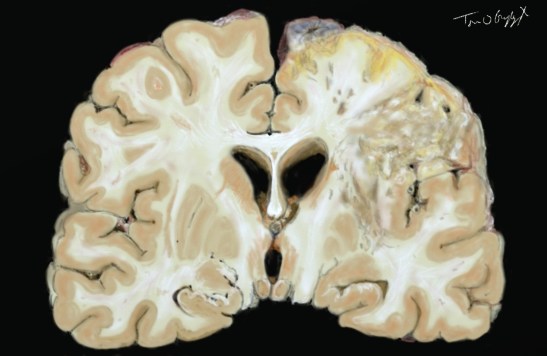 accident vasculaire cerebral AVC ischémique