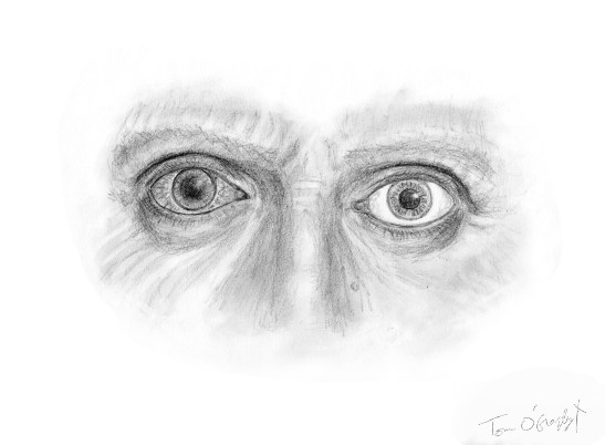 glaucome aigu angle ferme