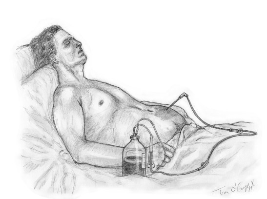 ponction-lavage hemoperitoine