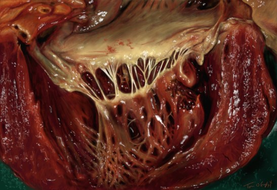 rupture cardiaque muscle papillaire pilier