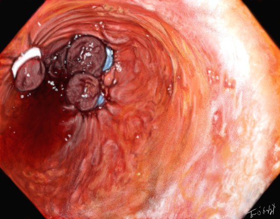 Ligature de varices oesophagiennes en endoscopie
