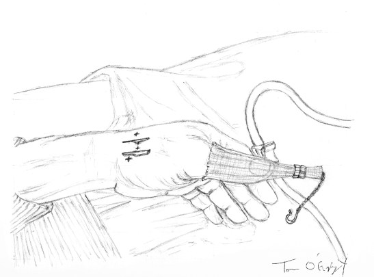 fracture pouce premier metacarpien reduction