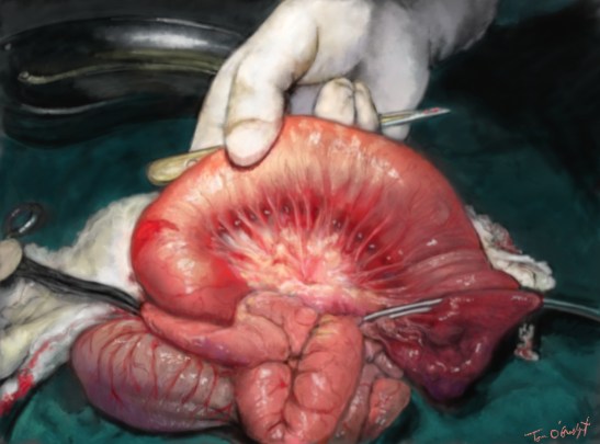 occlusion intestin grele obstruction ascaris