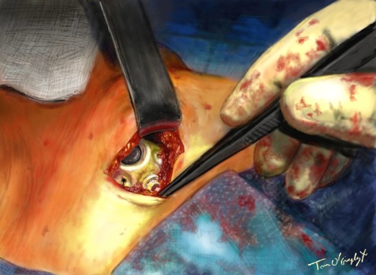 port-a-cath chambre implantable boitier