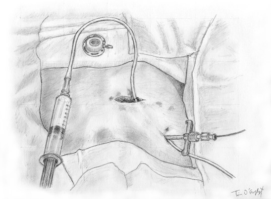 port-a-cath chambre implantable pose