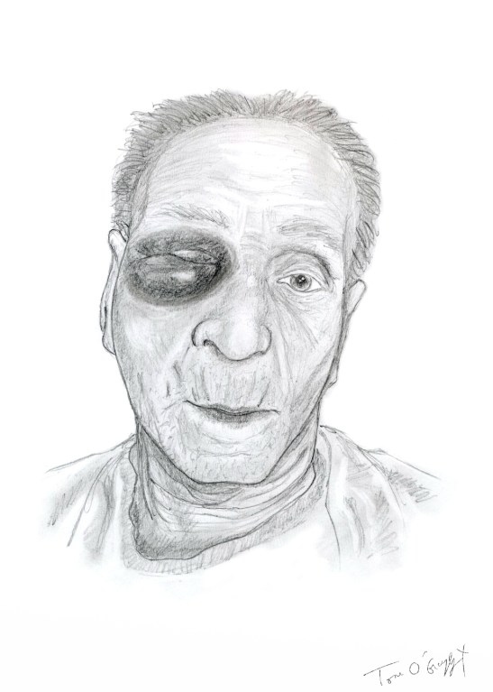 fracture massif facial orbite