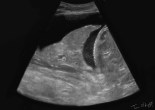 pleuresie echographie epanchement pleural